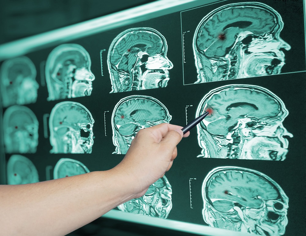Kings Mountain Brain Injury Lawyer