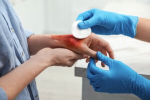 Shelby Burn Injury Lawyer