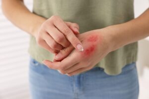 Tryon Burn Injury Lawyer