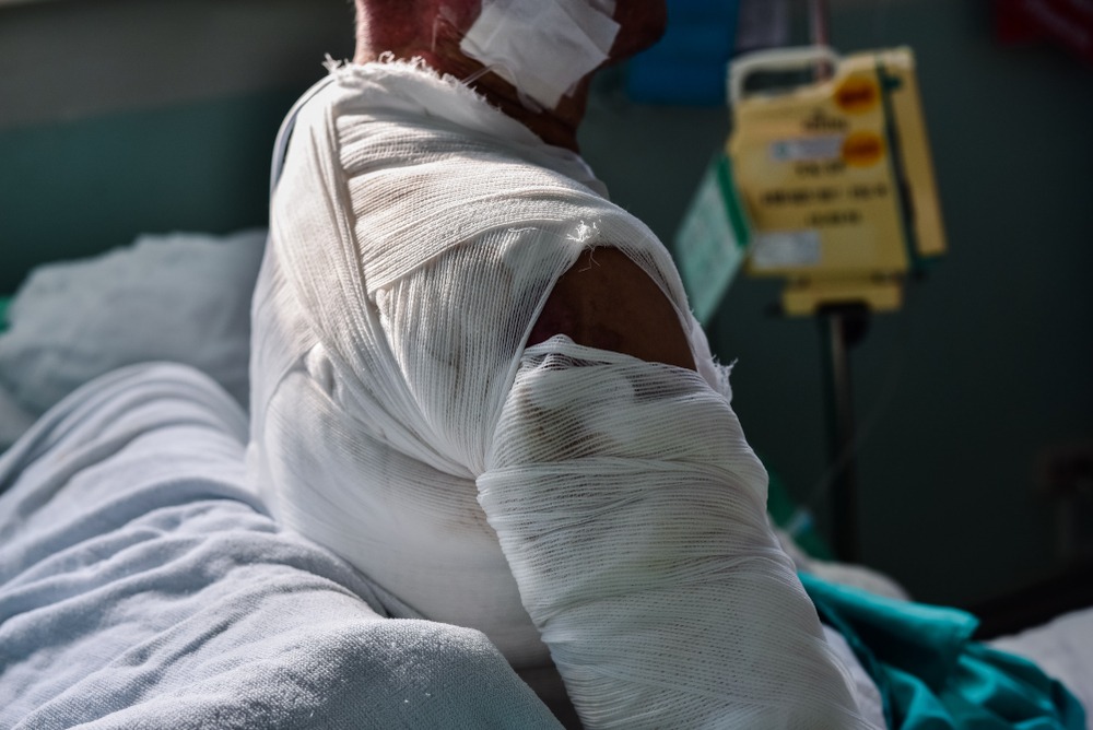 Forest City Burn Injury Lawyer