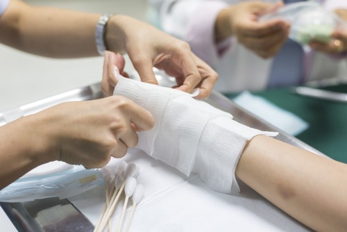Columbus Burn Injury Lawyer