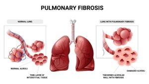 Does Pulmonary Fibrosis Qualify for Disability?