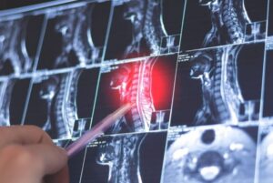 Does Degenerative Disc Disease Qualify for Disability?