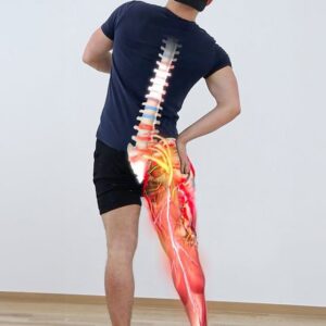 Does Sciatica Qualify for Disability?